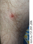 Воспалённый прыщ на коже ноги, гнойник. Inflamed acne on the leg skin, abscess. Стоковое фото, фотограф Юрий Пуликов / Фотобанк Лори