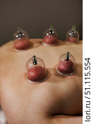 Releasing Tension Through Vacuum Cupping Therapy Treatment. Стоковое фото, фотограф Aleksandr Golubev / Фотобанк Лори