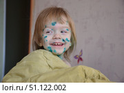 Ребёнок заболел ветрянкой. Стоковое фото, фотограф Светлана Первухина / Фотобанк Лори