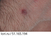 Scar on the skin of the hand from a chemical burn. Стоковое фото, фотограф Олег Тараканов / Фотобанк Лори