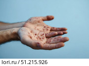 Human Hands with Painful Rash, Red Spots Blisters on the Skin. Health Problem. Monkeypox Disease Symptoms. Male Patient Arms with Monkey Pox. Close Up. Dengue Fever Infection, MPOX. Herpes, Pox Virus. Стоковое AI-изображение, AI-художник Марина Демидюк / Фотобанк Лори
