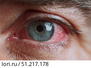 Human Eye with Conjunctivitis extreme close up. Closeup irritated infected red bloodshot eye. Male Eye. Vision. Eyesight. Adult Pain Eye Opening Wide. Viral infection with redness of eyeball. Macro. Стоковое AI-изображение, AI-художник Марина Демидюк / Фотобанк Лори