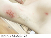 Woman with shingles on the skin she feels very painful. Стоковое фото, фотограф Anastasia Kayander / Фотобанк Лори