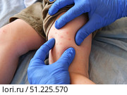 Doctor examining child with bodily red rash. Kid allergy closeup. Little baby scratches an eruption. Nurse applies special cream to atopic skin. Dermatitis, irritation, hive. Pruritus. Mosquito bites. Стоковое фото, фотограф Марина Демидюк / Фотобанк Лори