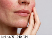 Sensitive skin. Woman scratches cheek with red rash, allergy symptom. Skin irritation, dermatitis, itchy skin problem. Face affected with Allergic reaction. Person suffering from itching, scratching. Стоковое AI-изображение, AI-художник Марина Демидюк / Фотобанк Лори