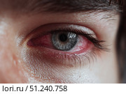 Human Eye with Conjunctivitis extreme close up. Closeup irritated infected red bloodshot eye. Male Eye. Vision. Eyesight. Adult Pain Eye Opening Wide. Viral infection with redness of eyeball. Macro. Стоковое AI-изображение, AI-художник Марина Демидюк / Фотобанк Лори