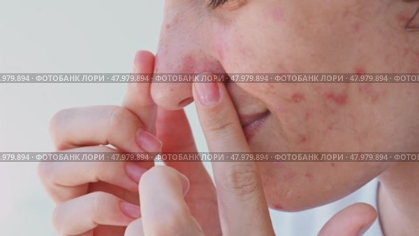 A young Caucasian girl with black dots on her nose on a gray background. The girl shows black dots with her hands. The problem of acne, comedones. Enlarged pores on the face. Стоковое видео, видеограф Корчагина Анастасия / Фотобанк Лори