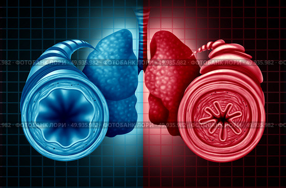 Asthma health diagnosis as a diagram with a healthy and unhealthy bronchial tube with a constricted breathing  problem caused by respiratory muscle tightening with 3D illustration elements.. Asthma Health Diagnosis. Стоковое фото, агентство Ingram Publishing / Фотобанк Лори
