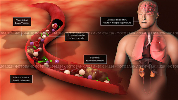 Biomedical illustration of sepsis in the bloodstream, triggering inflammatory responses throughout the body. Стоковое фото, фотограф Stocktrek Images, Inc. / ТАСС / Фотобанк Лори