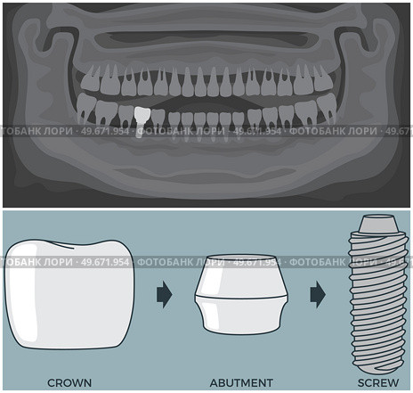 Black and white x-ray of human jaw with normal teeth and prosthesis above structure of dental implant. Tooth after medical procedure, dental treatment. Oral implantation. Radiograph with prosthesis. Black and white x-ray of human jaw with teeth and prosthesis above structure of dental implant. Стоковая иллюстрация, агентство Ingram Publishing / Фотобанк Лори