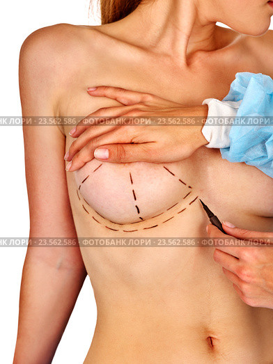 Breast cancer surgery. Doctor makes dotted line female body. Стоковое фото, фотограф Gennadiy Poznyakov / Фотобанк Лори