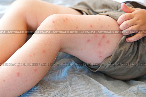 Child scratch body has sensitive itchy skin. Bodily rash. Kid allergy closeup. Little baby scratches eruption. Irritation, hive. Pruritus. Mosquito insect bite. Red from sunburn, Seborrheic Dermatitis. Стоковое фото, фотограф Марина Демидюк / Фотобанк Лори