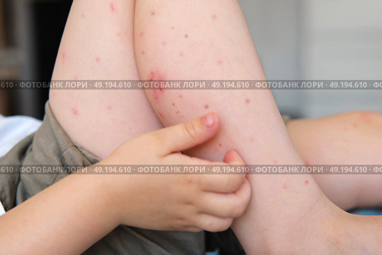 Child scratch body has sensitive itchy skin. Bodily rash. Kid allergy closeup. Little baby scratches eruption. Irritation, hive. Pruritus. Mosquito insect bite. Red from sunburn, Seborrheic Dermatitis. Стоковое фото, фотограф Марина Демидюк / Фотобанк Лори