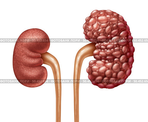 Chronic Kidney Disease or CKD as Human kidneys concept as one healthy and polycystic disease with cysts as anatomy of the urinary system on with a white background in a 3D illustration style. Стоковое фото, агентство Ingram Publishing / Фотобанк Лори