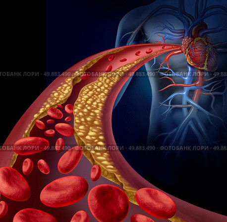 Clogged artery and atherosclerosis disease medical concept with a three dimensional human artery with blood cells that is blocked by plaque buildup of cholesterol as a symbol of arteriosclerotic vascular diseases. Стоковое фото, агентство Ingram Publishing / Фотобанк Лори