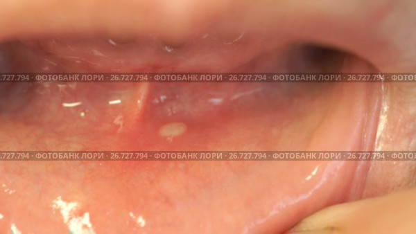 Close-up of stomatitis into mouth. Стоковое видео, видеограф worker / Фотобанк Лори
