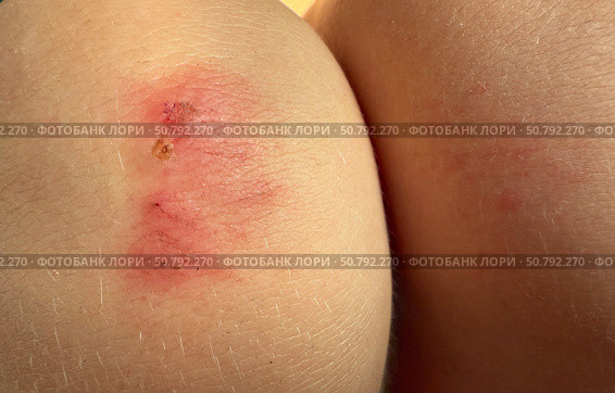Close-up view of a scraped knee with visible abrasions and redness. Concept of: Skin injury. Стоковое фото, фотограф Ольга Петрова-Апостолова / Фотобанк Лори