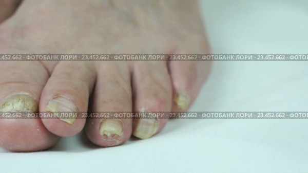 Грибковая инфекция на ногтях ног женщины. Стоковое видео, видеограф worker / Фотобанк Лори