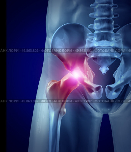 Hip pain as an inflamed joint with an x-ray medical illustration of a frontal close up macro of a human skeleton with a painful area in red as a chronic disease and injury to bone needing hip replacement surgery. Стоковое фото, агентство Ingram Publishing / Фотобанк Лори