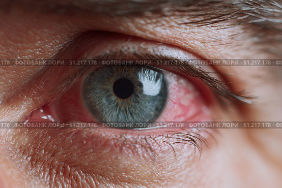 Human Eye with Conjunctivitis extreme close up. Closeup irritated infected red bloodshot eye. Male Eye. Vision. Eyesight. Adult Pain Eye Opening Wide. Viral infection with redness of eyeball. Macro. Стоковое AI-изображение, AI-художник Марина Демидюк / Фотобанк Лори