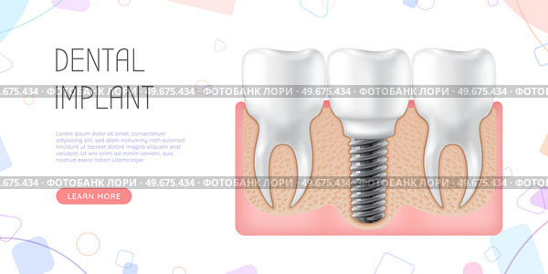 Human jaw with normal teeth and prosthesis above dental implant structure. Tooth after dental procedure. Surgical implant in oral cavity. Treatment, dentistry, oral care. Healthy tooth in human gum. Human jaw with normal healthy teeth and prosthesis in gum above structure of dental implant. Стоковая иллюстрация, агентство Ingram Publishing / Фотобанк Лори