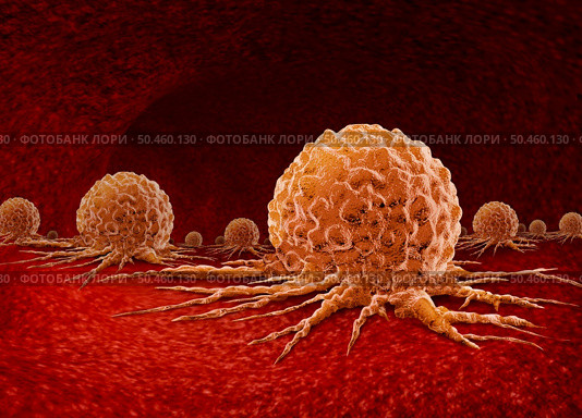 Malignant Cancer Growth and Metastasis anatomy concept as a growing tumor cell and Malignancy disease growth on an organ inside the human body as a 3D illustration. Стоковое фото, агентство Ingram Publishing / Фотобанк Лори