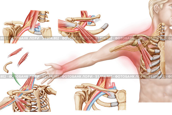 Medical illustration detailing thoracic outlet syndrome. Стоковое фото, фотограф Stocktrek Images, Inc. / ТАСС / Фотобанк Лори