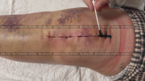 Medical sutures, stitch after surgery, stitched surgical sutures on human body smeared betadine. Medical surgical care. Close-up. Стоковое видео, видеограф Ирина Старикова / Фотобанк Лори
