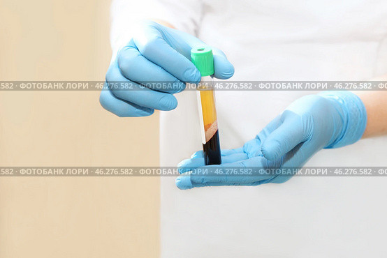 Medical test tube with blood Plasma in his hands for PRP therapy. Стоковое фото, фотограф Ольга Зиновская / Фотобанк Лори