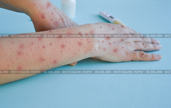 Monkey pox virus, a new world problem of modern humanity. Close-up of the hands of a sick person with pimples and blisters. Стоковое фото, фотограф Ирина Старикова / Фотобанк Лори