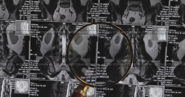 MRI lumbar spine background, magnetic resonance tomography. Doctor examines MRI of lumbar spine with pinched discs of spine and nerves. Стоковое видео, видеограф Андрей Армягов / Фотобанк Лори