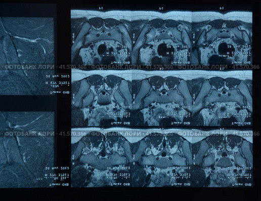 MRI sacroiliac articulation. Study of ankylosing spondyloarthritis patient. Стоковое фото, фотограф Леонид Еремейчук / Фотобанк Лори