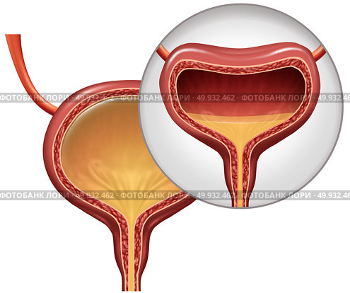 Overactive bladder and involuntary loss of urine concept as an uncomfortable condition in a human organ with 3D illustration elements. Стоковое фото, агентство Ingram Publishing / Фотобанк Лори