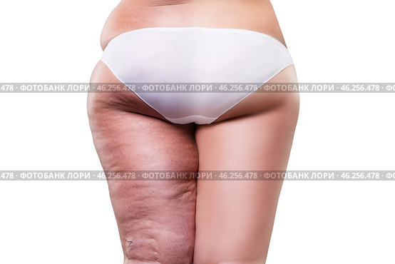 Overweight woman with fat cellulite legs and buttocks, before after concept, obesity female body, rear view. Стоковое фото, фотограф Станислав Тарко / Фотобанк Лори