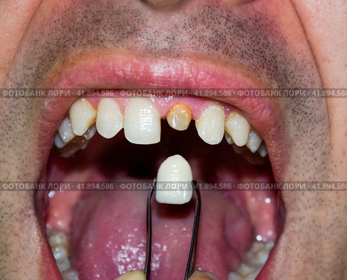 patient without a tooth is trying on a denture. Стоковое фото, фотограф Леонид Еремейчук / Фотобанк Лори