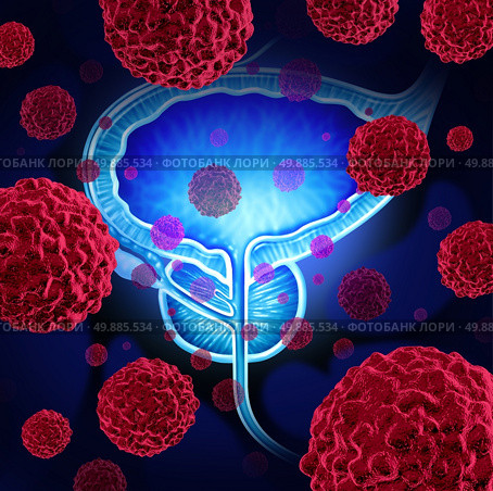 Prostate cancer danger medical concept as cancerous cells in a male body attacking the reproductive system as a symbol of human malignant tumor growth diagnosis treatment and risks.

. Стоковое фото, агентство Ingram Publishing / Фотобанк Лори