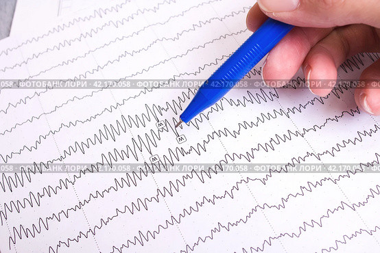Results of electroencephalogram on paper, diagnostics of epilepsy. Стоковое фото, фотограф Аксенова Вера / Фотобанк Лори