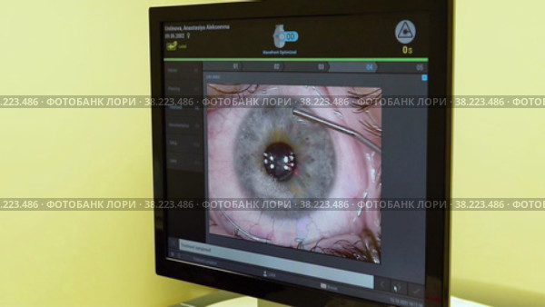 RUSSIA, VATUTINKI - OCT 13, 2022: Correction clinic eye surgery laser operation lens medicine lasik, from, ophthalmologist vision. Стоковое видео, видеограф ilya Lyubchenko / Фотобанк Лори