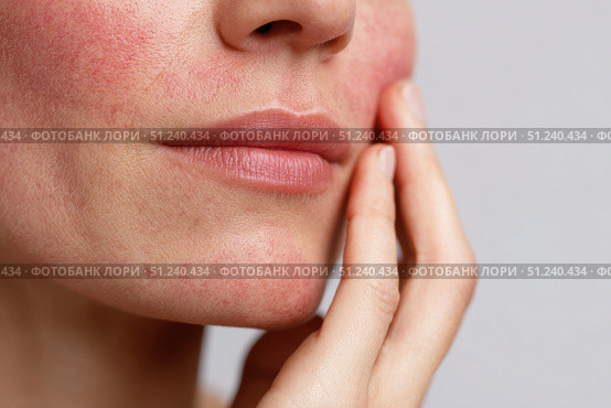 Sensitive skin. Woman scratches cheek with red rash, allergy symptom. Skin irritation, dermatitis, itchy skin problem. Face affected with Allergic reaction. Person suffering from itching, scratching. Стоковое AI-изображение, AI-художник Марина Демидюк / Фотобанк Лори