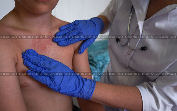 The doctor is checking the boy for signs of chickenpox or other illnesses. Стоковое фото, фотограф Ирина Старикова / Фотобанк Лори