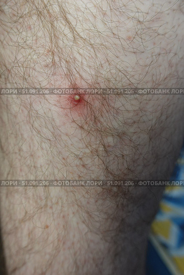 Воспалённый прыщ на коже ноги, гнойник. Inflamed acne on the leg skin, abscess. Стоковое фото, фотограф Юрий Пуликов / Фотобанк Лори