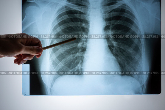 X-ray of the lungs. Chest x-ray. Doctor's view of the lung image in the hospital on a reflective board, blurred focus. Стоковое фото, фотограф Светлана Акифьева / Фотобанк Лори